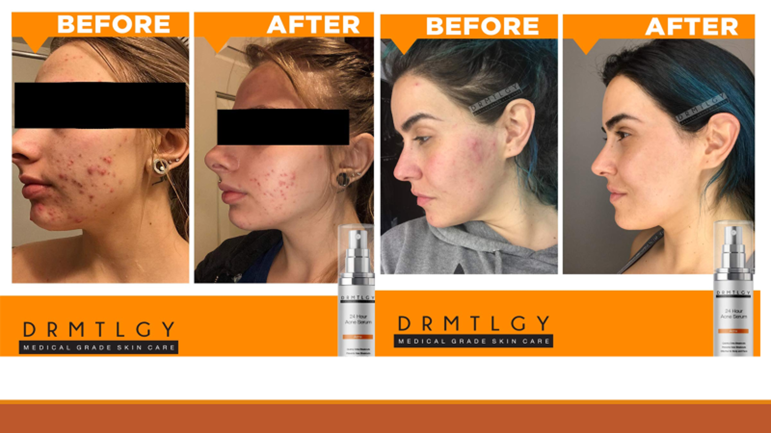 DRMTLGY Acne Spot Treatment and Cystic Acne Treatment. Acne Serum with